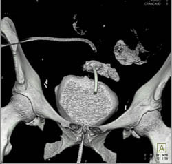 Fistulae From Bladder to Colon - CTisus CT Scan