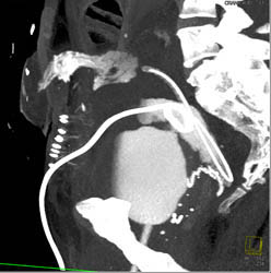 Fistulae From Bladder to Colon - CTisus CT Scan