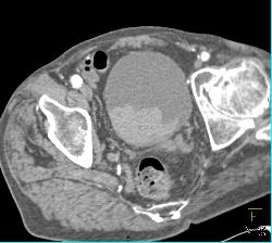 Bladder Hematoma With Active Bleed Seen in 3D - CTisus CT Scan