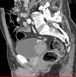 Bladder Hematoma With Active Bleed Seen in 3D - CTisus CT Scan