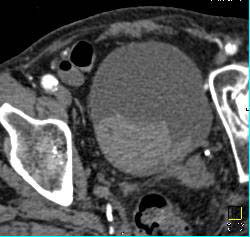 Bladder Hematoma With Active Bleed Seen in 3D - CTisus CT Scan