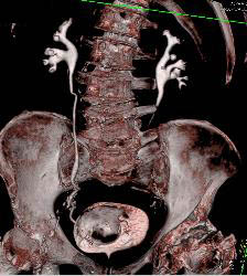 Bladder Hematoma With Active Bleed Seen in 3D - CTisus CT Scan