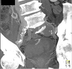 Bladder Hematoma With Active Bleed Seen in 3D - CTisus CT Scan