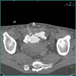 Neobladder - CTisus CT Scan