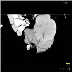 Neobladder - CTisus CT Scan