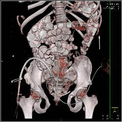 Neobladder - CTisus CT Scan