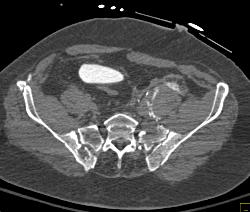 Pelvic Trauma With Bladder Rupture - CTisus CT Scan