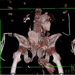 Pelvic Trauma With Bladder Rupture - CTisus CT Scan