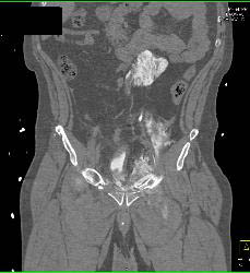 Pelvic Trauma With Bladder Rupture - CTisus CT Scan