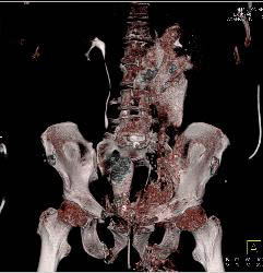 Pelvic Trauma With Bladder Rupture - CTisus CT Scan