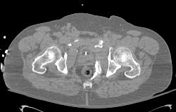 Pelvic Trauma With Bladder Rupture - CTisus CT Scan