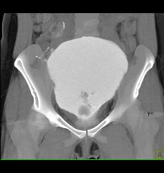 Bladder Perforation Seen in 3D - CTisus CT Scan