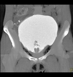 Bladder Perforation Seen in 3D - CTisus CT Scan