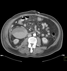 Right Perirenal Hematoma - CTisus CT Scan