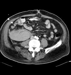 Right Perirenal Hematoma - CTisus CT Scan