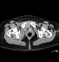 Pelvic Hematoma Displace the Bladder to the Right - CTisus CT Scan