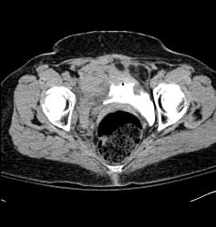 Pelvic Hematoma Displace the Bladder to the Right - CTisus CT Scan