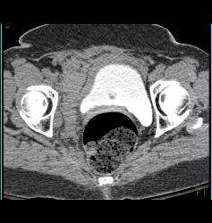 Pelvic Hematoma Displace the Bladder to the Right - CTisus CT Scan