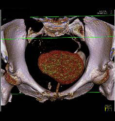 Pelvic Hematoma Displace the Bladder to the Right - CTisus CT Scan