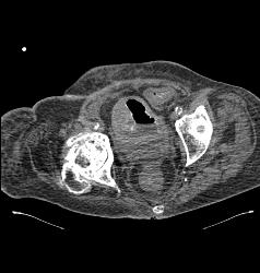 Bladder Cancer - CTisus CT Scan