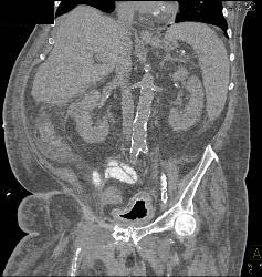 Bladder Cancer - CTisus CT Scan