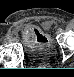 Bladder Cancer - CTisus CT Scan