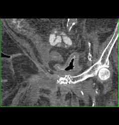 Bladder Cancer - CTisus CT Scan