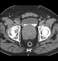 Bladder Cancer Near Ureterovesical Junction (UVJ) - CTisus CT Scan