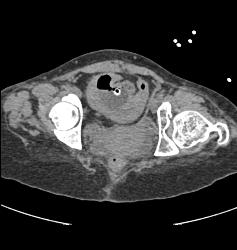 Pelvic Hematoma With Bladder Leak - CTisus CT Scan