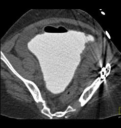 Pelvic Hematoma With Bladder Leak - CTisus CT Scan