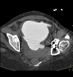 Pelvic Hematoma With Bladder Leak - CTisus CT Scan