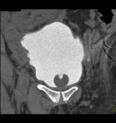 Pelvic Hematoma With Bladder Leak - CTisus CT Scan