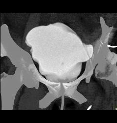 Pelvic Hematoma With Bladder Leak - CTisus CT Scan