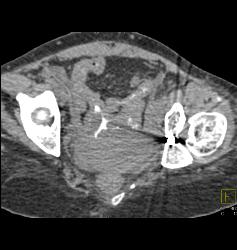 Pelvic Hematoma With Bladder Leak - CTisus CT Scan