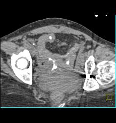 Pelvic Hematoma With Bladder Leak - CTisus CT Scan