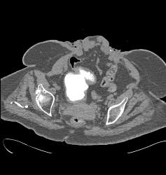 Neobladder - CTisus CT Scan