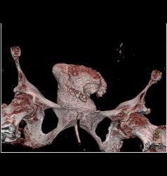 Neobladder - CTisus CT Scan