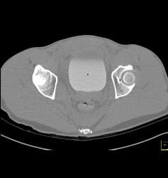 Pelvic Fractures and Hematoma - CTisus CT Scan