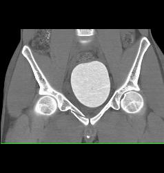 Pelvic Fractures and Hematoma - CTisus CT Scan