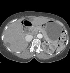 Pelvic Arteriovenous (AV) Fistulae With Early Filling of Right Iliac Vein and IVC - CTisus CT Scan