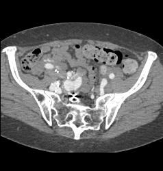 Pelvic Arteriovenous (AV) Fistulae With Early Filling of Right Iliac Vein and IVC - CTisus CT Scan