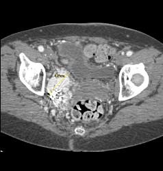 Pelvic Arteriovenous (AV) Fistulae With Early Filling of Right Iliac Vein and IVC - CTisus CT Scan