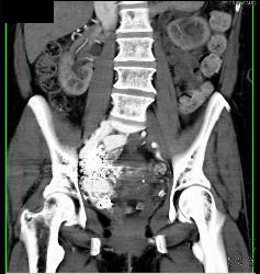 Pelvic Arteriovenous (AV) Fistulae With Early Filling of Right Iliac Vein and IVC - CTisus CT Scan