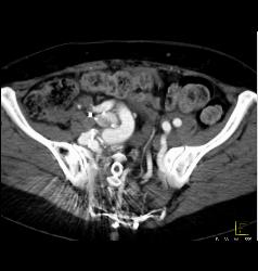 Pelvic Arteriovenous (AV) Fistulae With Early Filling of Right Iliac Vein and IVC - CTisus CT Scan