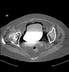 Emphysematous Cysititis - CTisus CT Scan