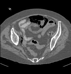 Emphysematous Cysititis - CTisus CT Scan