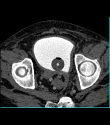 Bladder Cancer - CTisus CT Scan