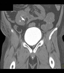 Bladder Cancer - CTisus CT Scan