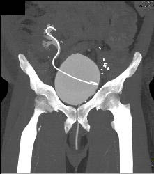 Bladder Cancer - CTisus CT Scan