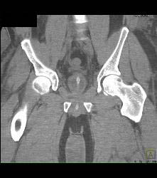 Bladder Cancer - CTisus CT Scan